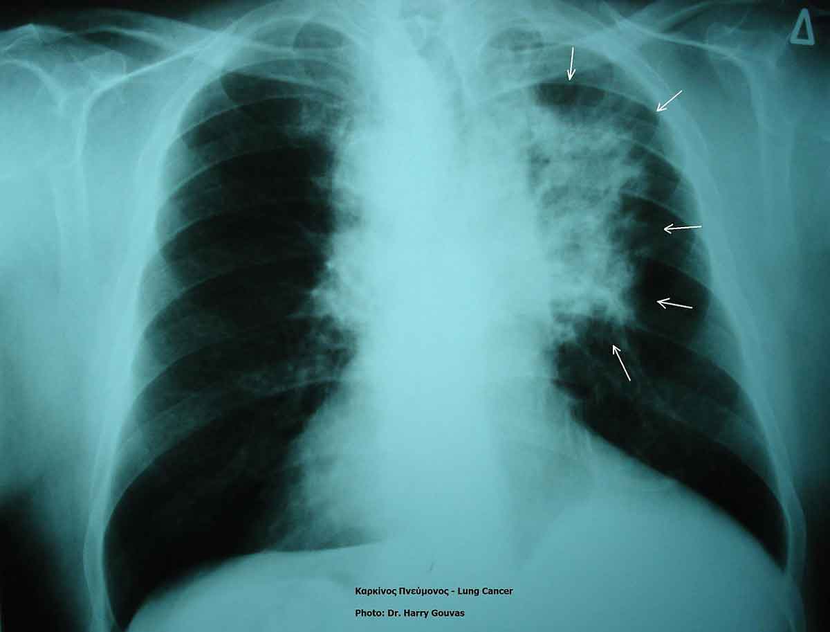 Thoracic Oncology